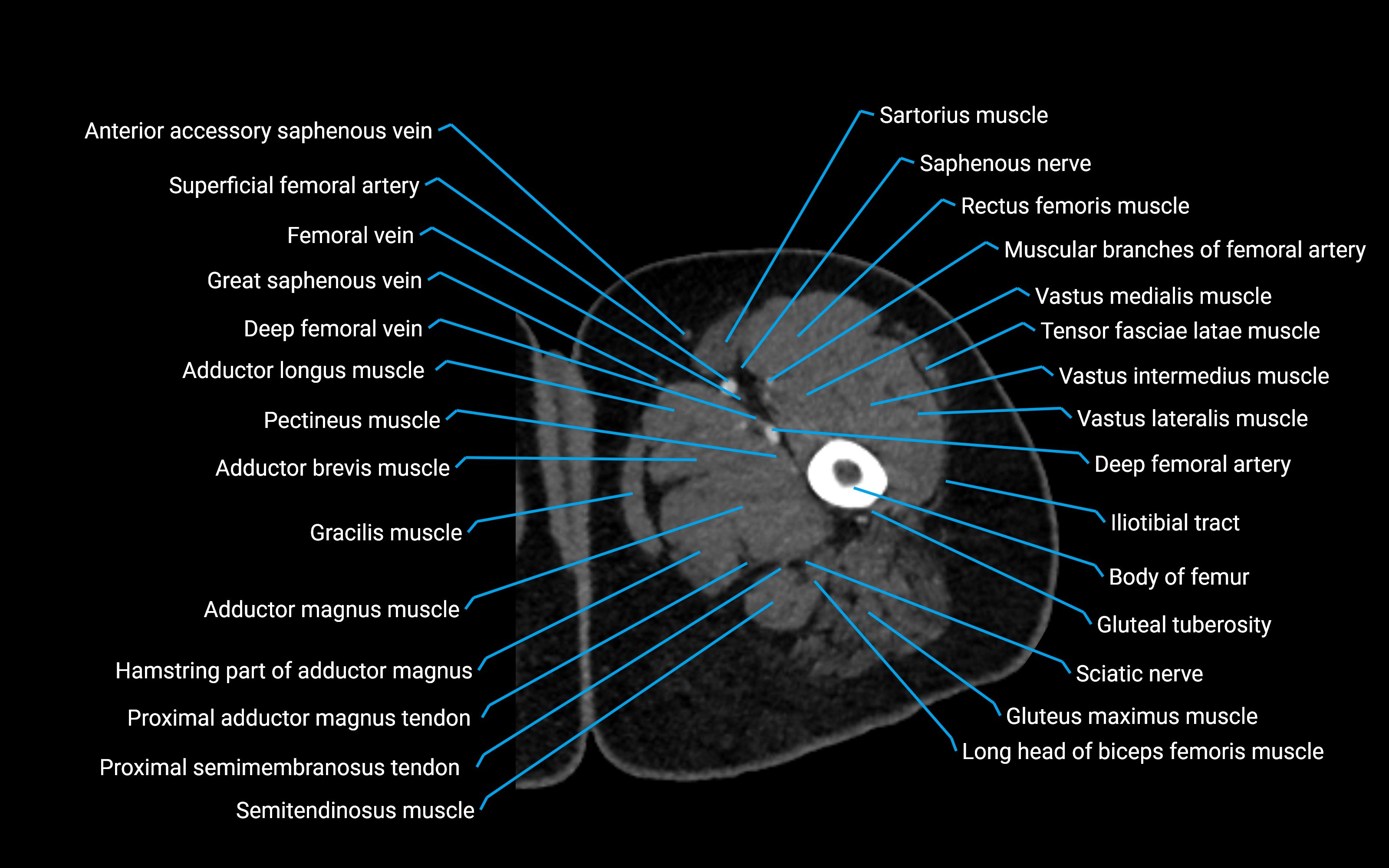 CT Hip axial cross sectional anatomy labelled image 26 (3).png